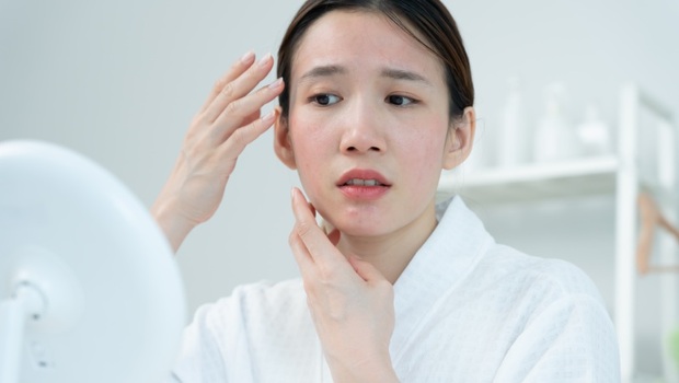 不是沒洗乾淨！為什麼30歲還在長痘？醫師揭關鍵「不是清潔，是●●太多」