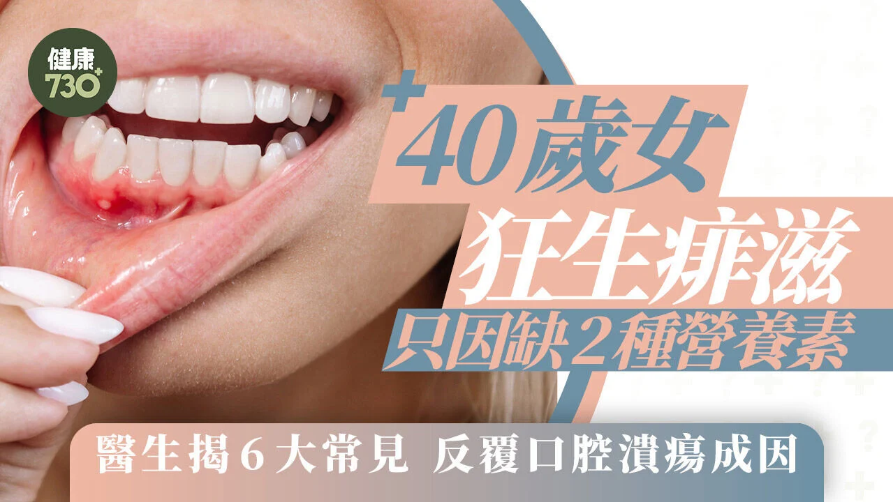 口腔潰瘍｜40歲女狂生痱滋 只因缺2種營養素 醫生揭6大常見反覆口腔潰瘍成因 - AM730