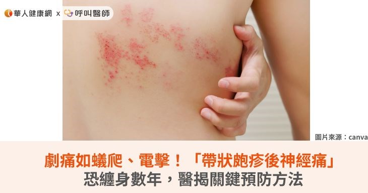 劇痛如蟻爬、電擊！「帶狀皰疹後神經痛」恐纏身數年，醫揭關鍵預防方法