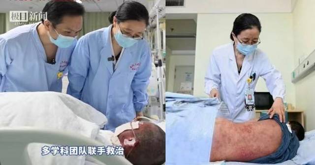 眼痛服藥打針後患罕見重症 武漢10歲男童全身逾8 成皮膚剝落如嚴重燒傷 - 巴士的報