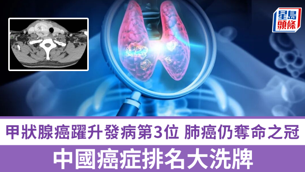 中國癌症排名大洗牌｜甲狀腺癌躍升發病第3位 肺癌仍奪命之冠 - Sing Tao Daily 星島日報加拿大