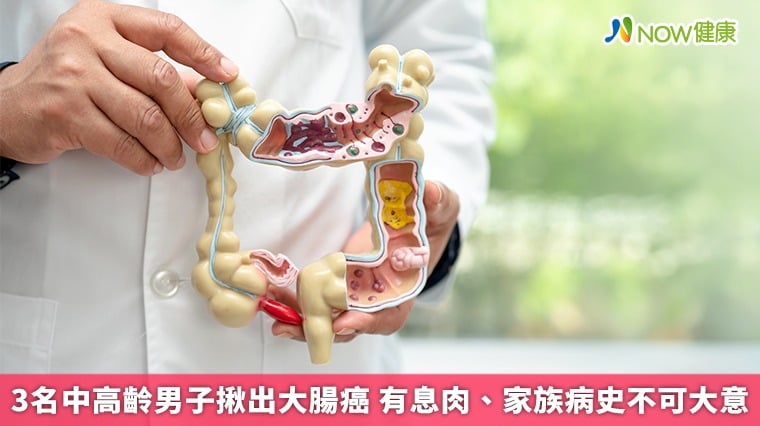 3名中高齡男子揪出大腸癌 有息肉、家族病史不可大意