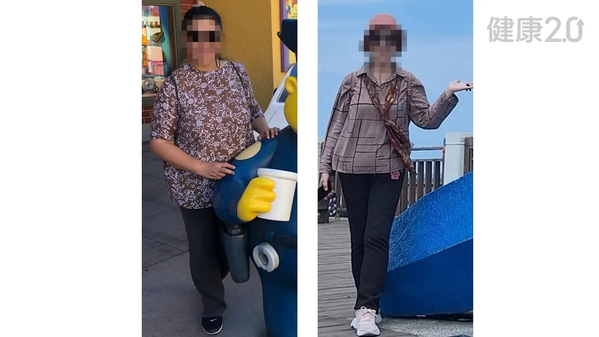 醫療焦點體重101公斤膝痛難行！63歲婦減重近40公斤 免換人工膝關節