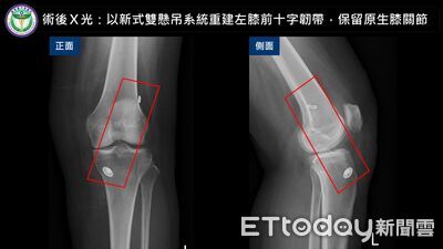 55歲婦走樓梯軟腳　國軍台中總醫院新術式助韌帶增粗至9毫米