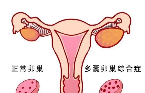 多囊一直懷不上要不要促排?從排卵檢查、輸卵管到男方精子全面評估