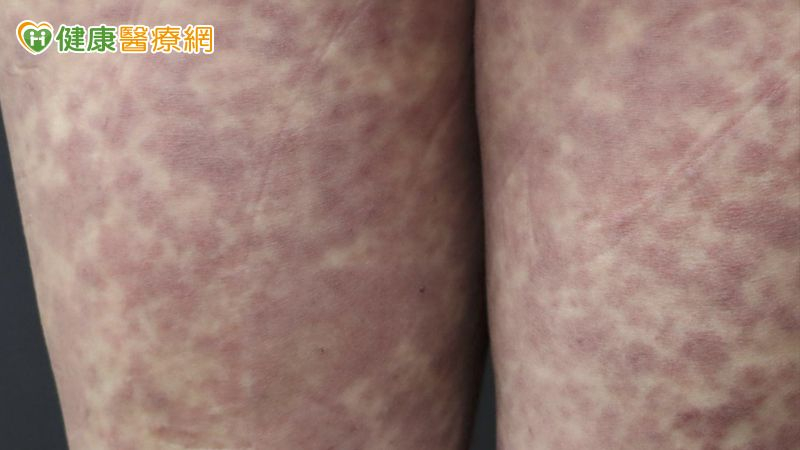 37歲女吃藥發燒出疹 檢測揪出複方藥「這成分」致敏