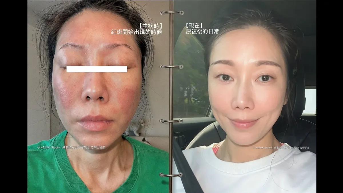 健康星聞舞蹈名師KIMIKO全身紅斑急送醫！醫揭過敏元凶：除蟎後還要做1事