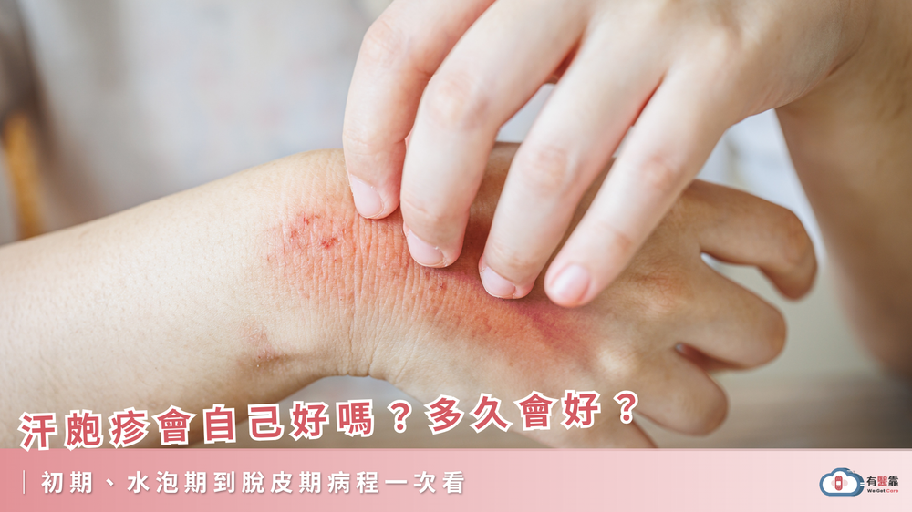 汗皰疹會自己好嗎？多久會好？初期、水泡期到脫皮期病程一次看