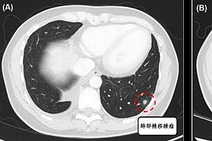 癌症寡轉移不等於無治療機會 SBRT縮短療程、減少正常組織傷害
