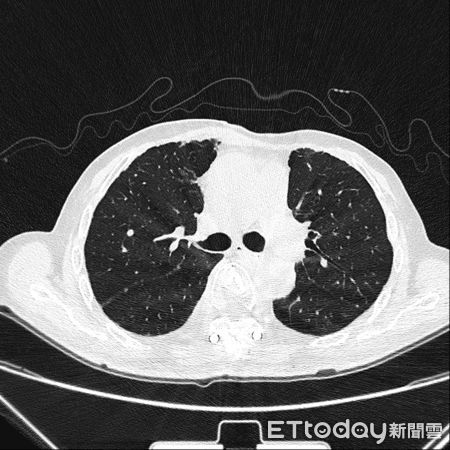 中國「癌王」排名大洗牌甲狀腺癌爆發式增長至第三- 股市爆料同學會 - CMoney