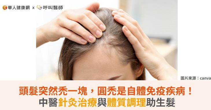 頭髮突然禿一塊，圓禿是自體免疫疾病！中醫針灸治療與體質調理助生髮