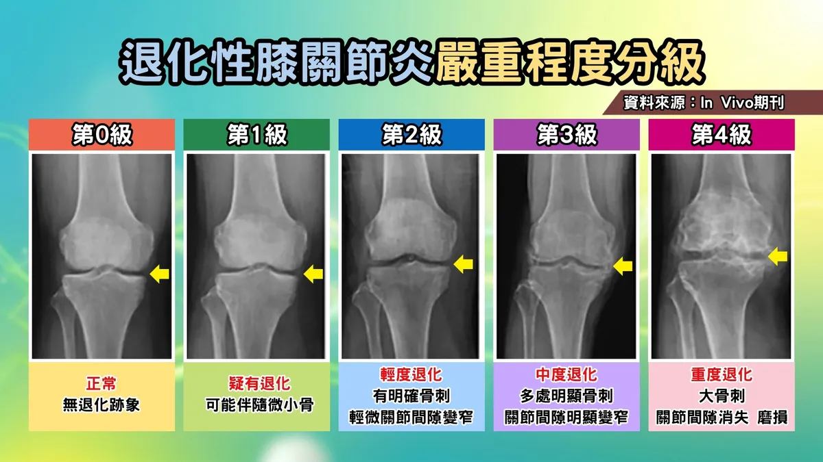 養生保健膝軟骨磨損只能換人工關節？自體軟骨修復術成新選擇 1次完成免開2次刀