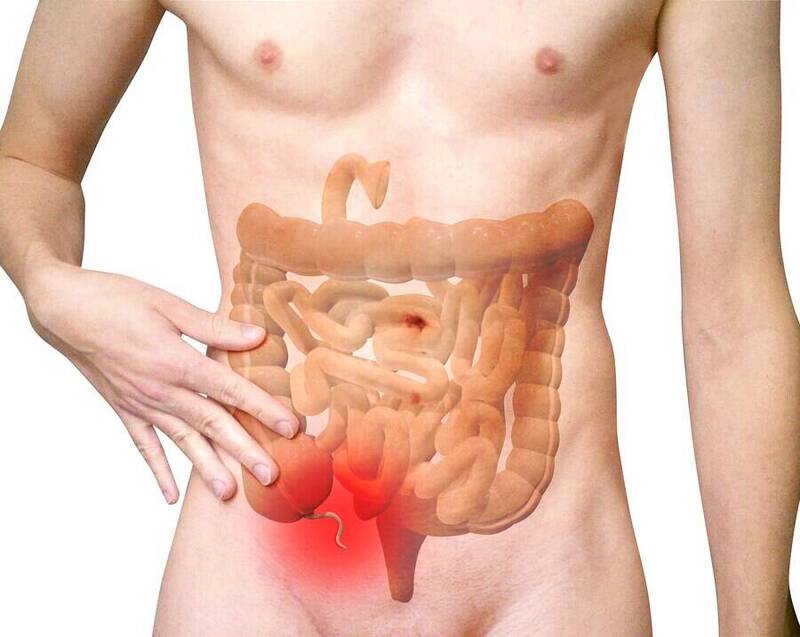 闌尾炎開刀竟牽動大腸癌風險？美3萬人研究揭58％差異 - 自由健康網