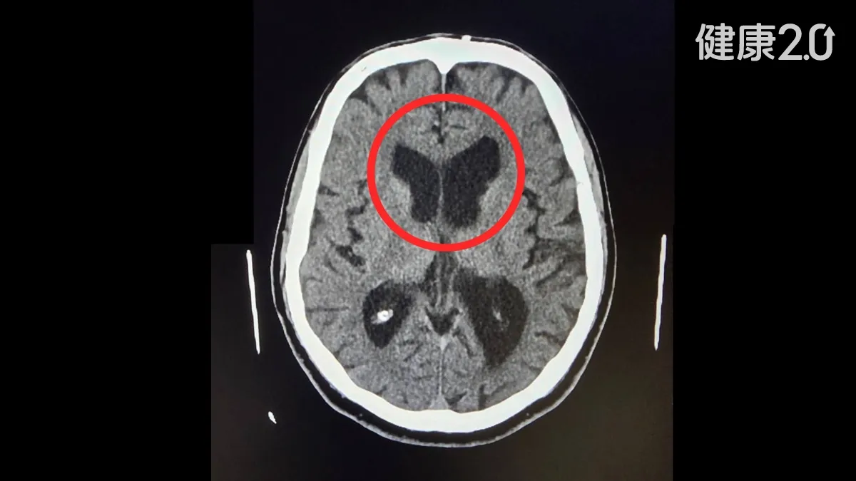 醫療焦點退休男迷路跌倒誤認失智！手術復健逆轉「常壓性水腦症」助重返山林