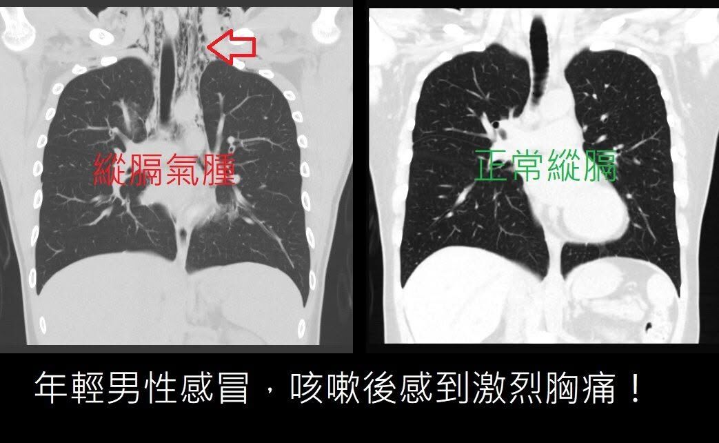 只是感冒咳嗽！年輕男「一直胸痛」衝急診　肺泡竟破了 - ETtoday新聞雲