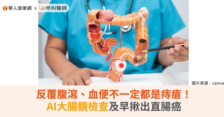 反覆腹瀉、血便不一定都是痔瘡！AI大腸鏡檢查及早揪出直腸癌