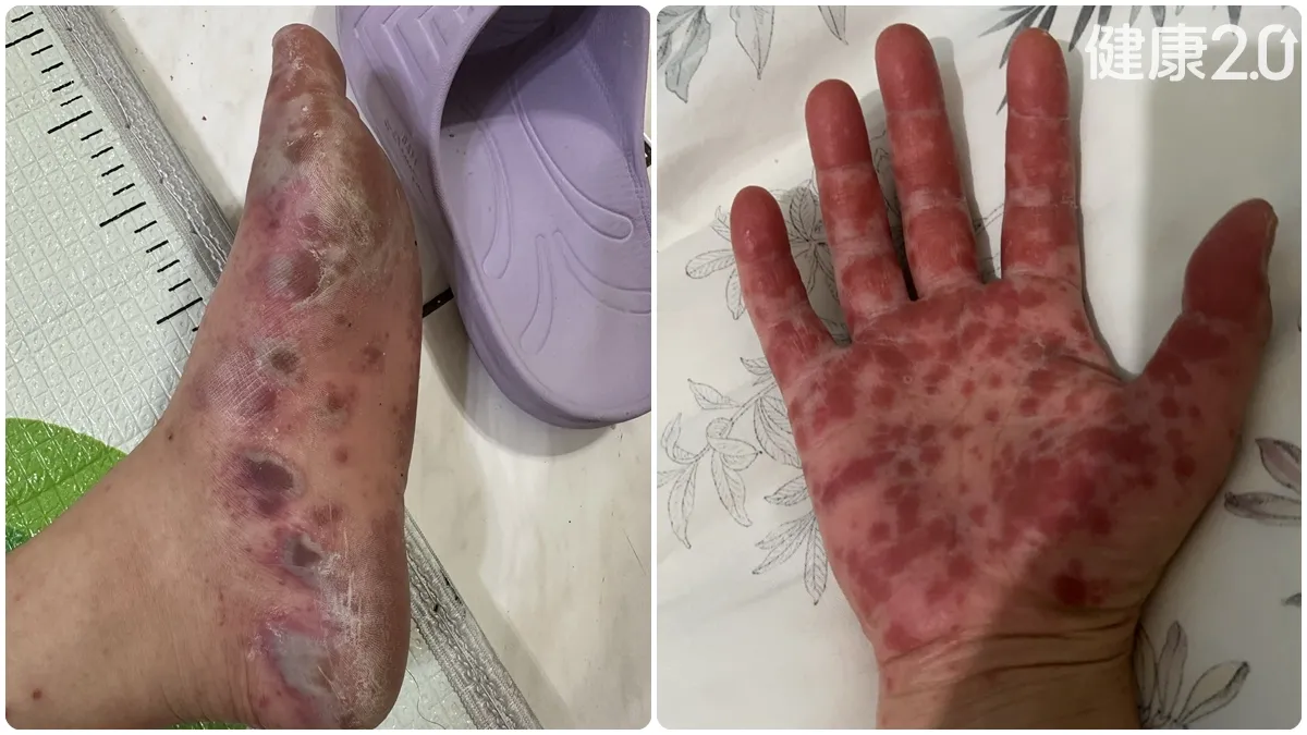 防疫快遞成人也會得腸病毒！手腳水泡痛到不能走 醫揭這型病毒恐讓「指甲整排掉光」