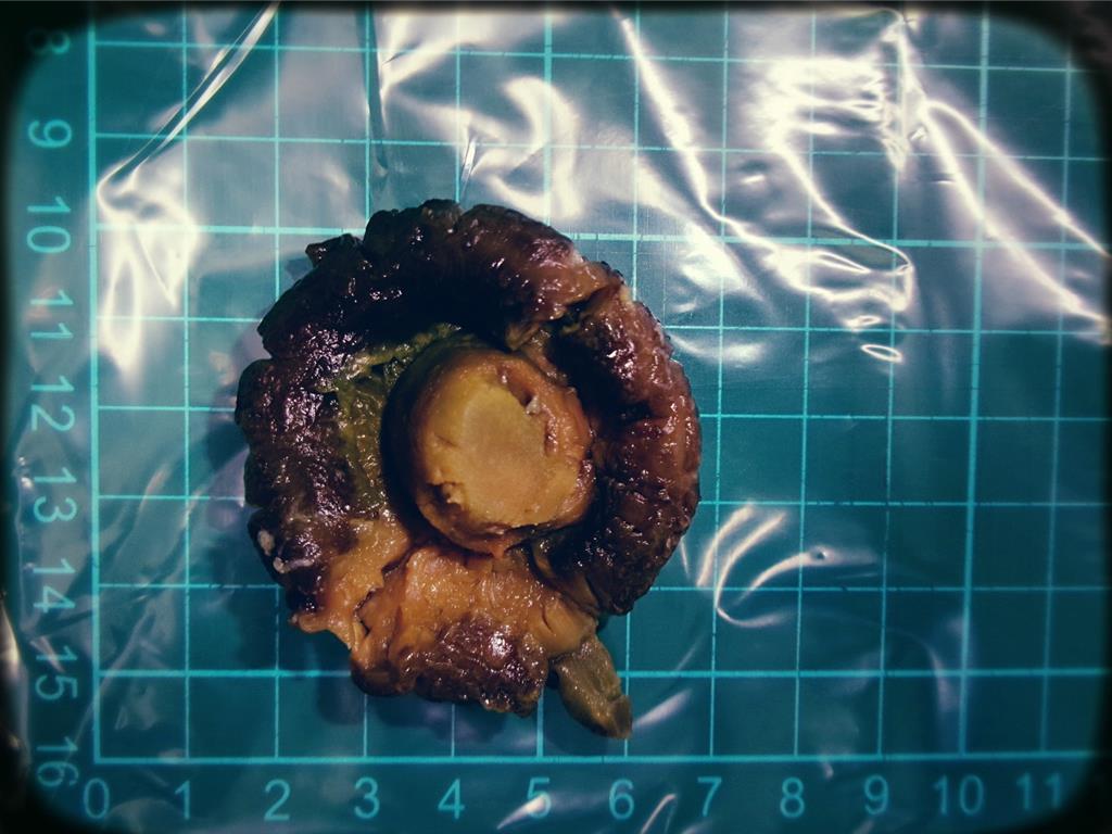 六旬男腸阻塞手術驚奇　一朵完整香菇卡腸道