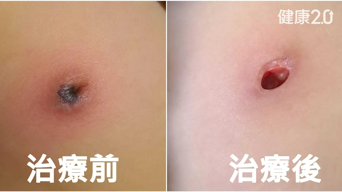 醫療焦點微小抓傷變大洞！乳頭竟被吃光 醫：水跟土壤都有這菌