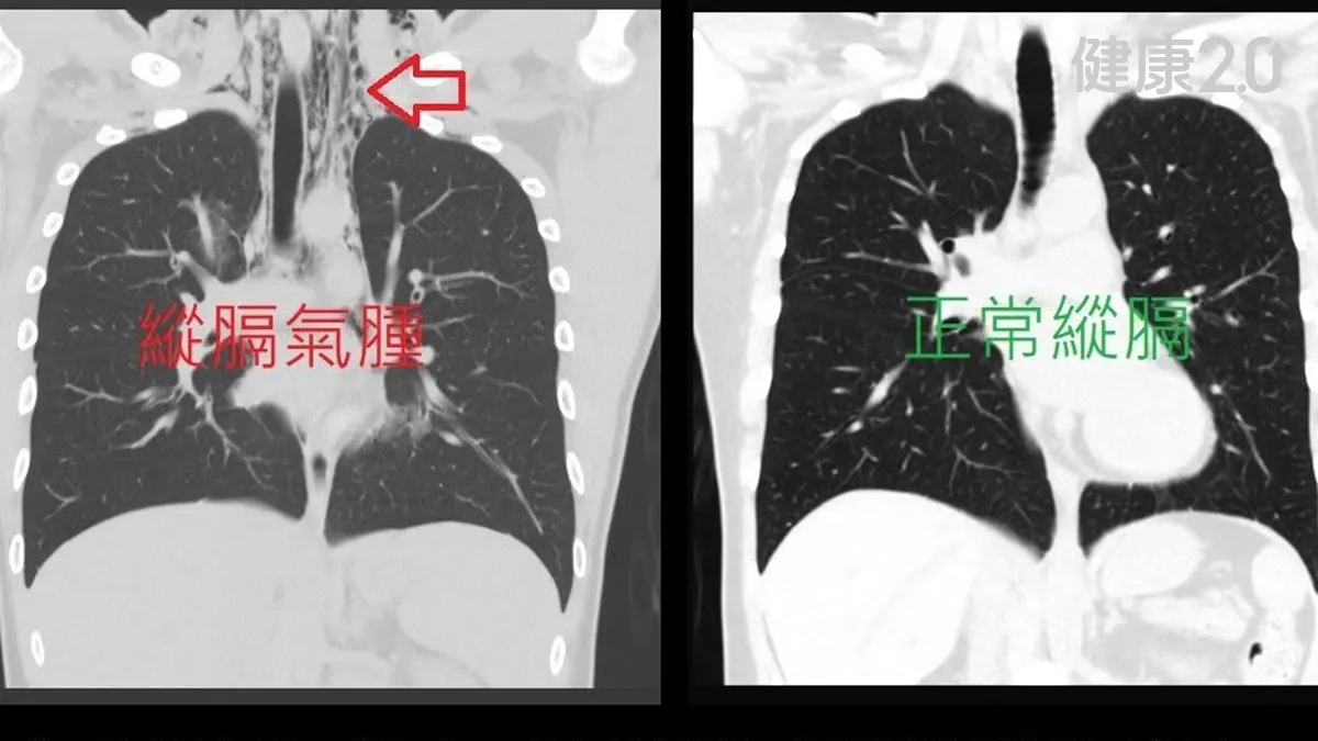 醫療焦點男感冒咳嗽前胸痛到後背竟是肺泡被咳破！蘇一峰提醒「這種體型」男性最容易發生