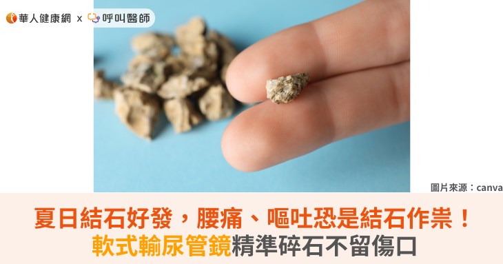 夏日結石好發，腰痛、嘔吐恐是結石作祟！軟式輸尿管鏡精準碎石不留傷口