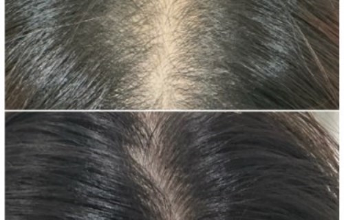 心得分享: 絲凱鉑診所救了我的白頭髮