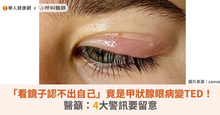 「看鏡子認不出自己」竟是甲狀腺眼病變TED！醫籲：4大警訊要留意
