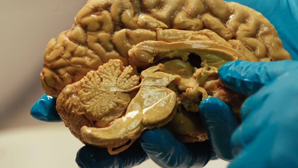 人類大腦竟是「兩個器官」 驚人研究或有助漸凍人症治療 - singtao.ca