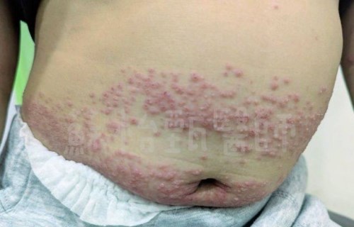 4歲男童完全沒發燒、全身長滿水泡！醫示警：「這型腸病毒」顛覆眾人認知
