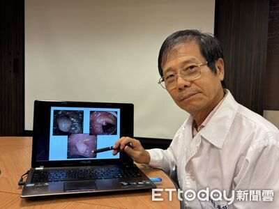 血便、追蹤息肉揪癌！醫曝3案例：一等親罹大腸癌風險倍增