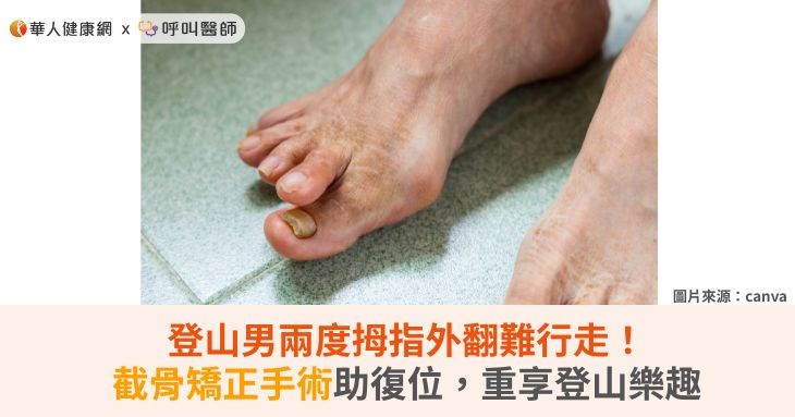 登山男兩度拇指外翻難行走！截骨矯正手術助復位，重享登山樂趣