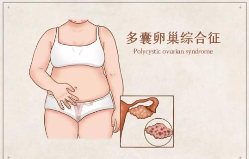 多囊卵巢減肥點食先有效?香港女性控制體重、改善胰島素阻抗飲食攻略