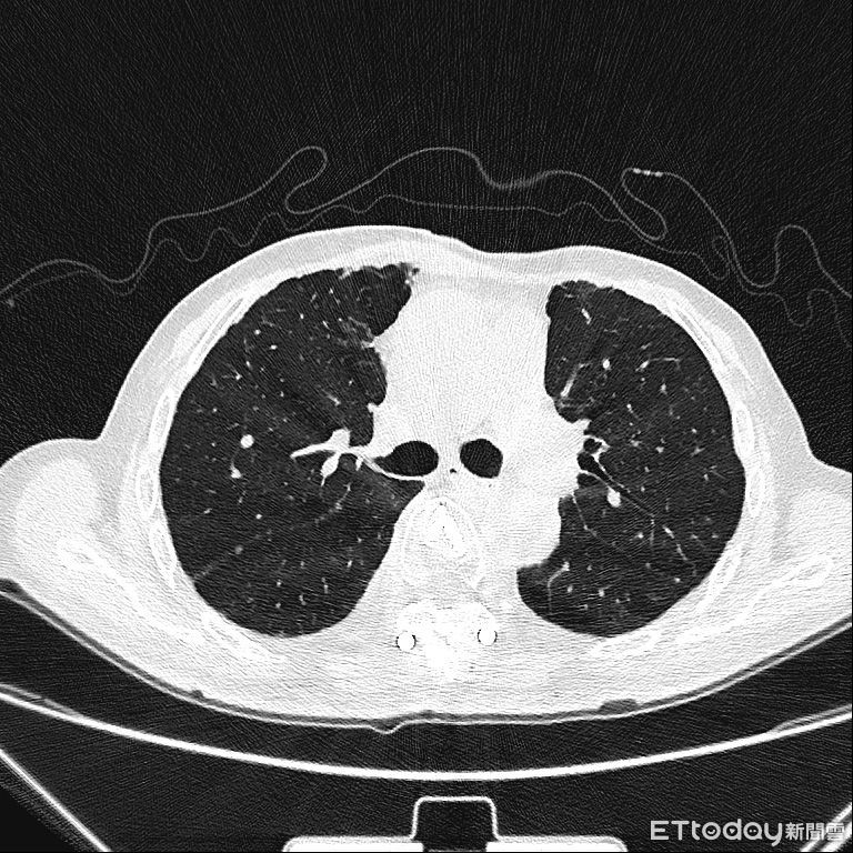 中國「癌王」排名大洗牌　甲狀腺癌爆發式增長至第三 - ETtoday新聞雲