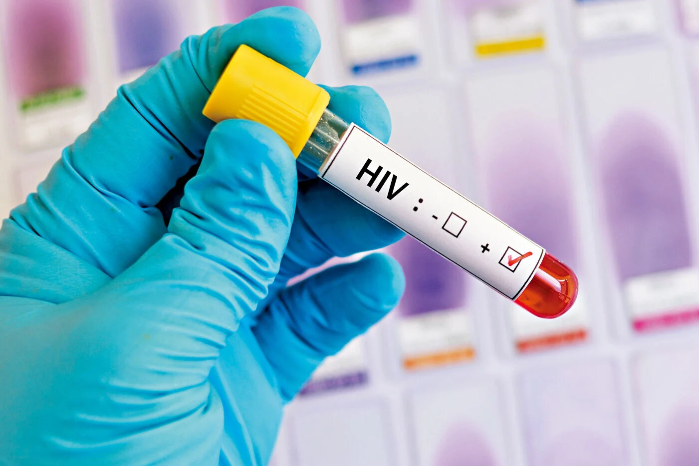 確診HIV即日治療減傳播 逾九成人支持 - AM730