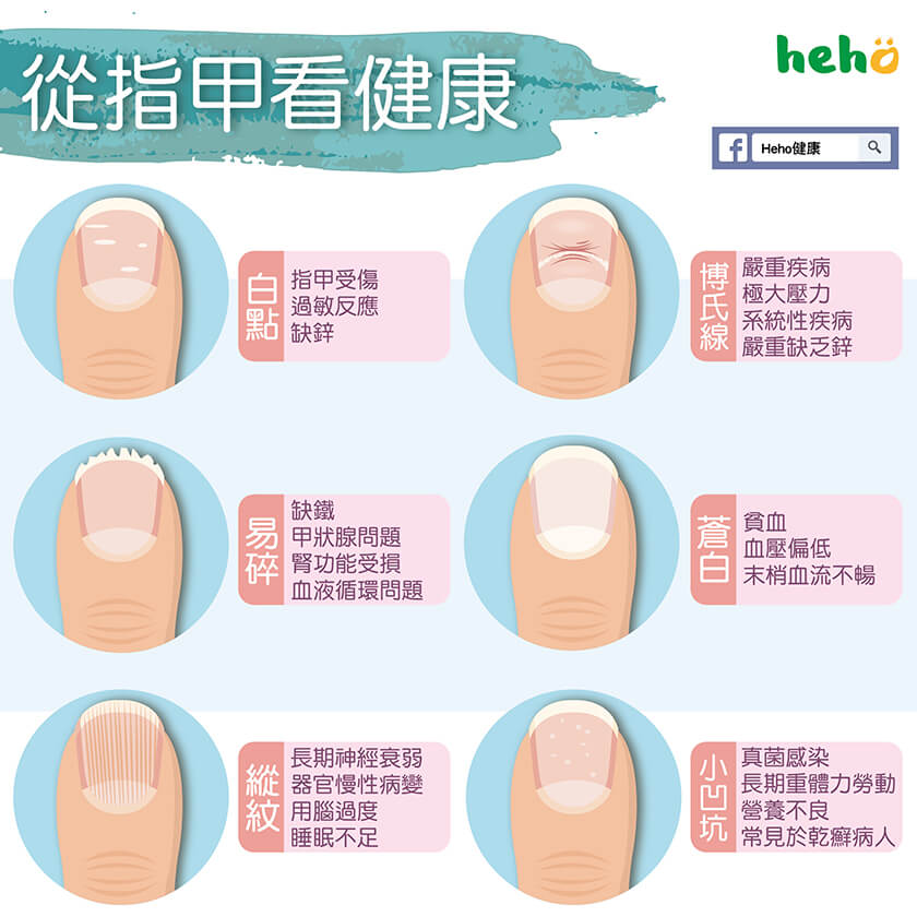 從指甲看你身體可能發生什麼問題 !!