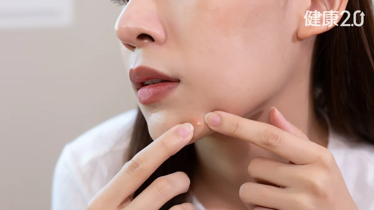 營養對策青春痘是吃出來的？巧克力、炸物竟非元凶 醫點名「這類食物」更要小心