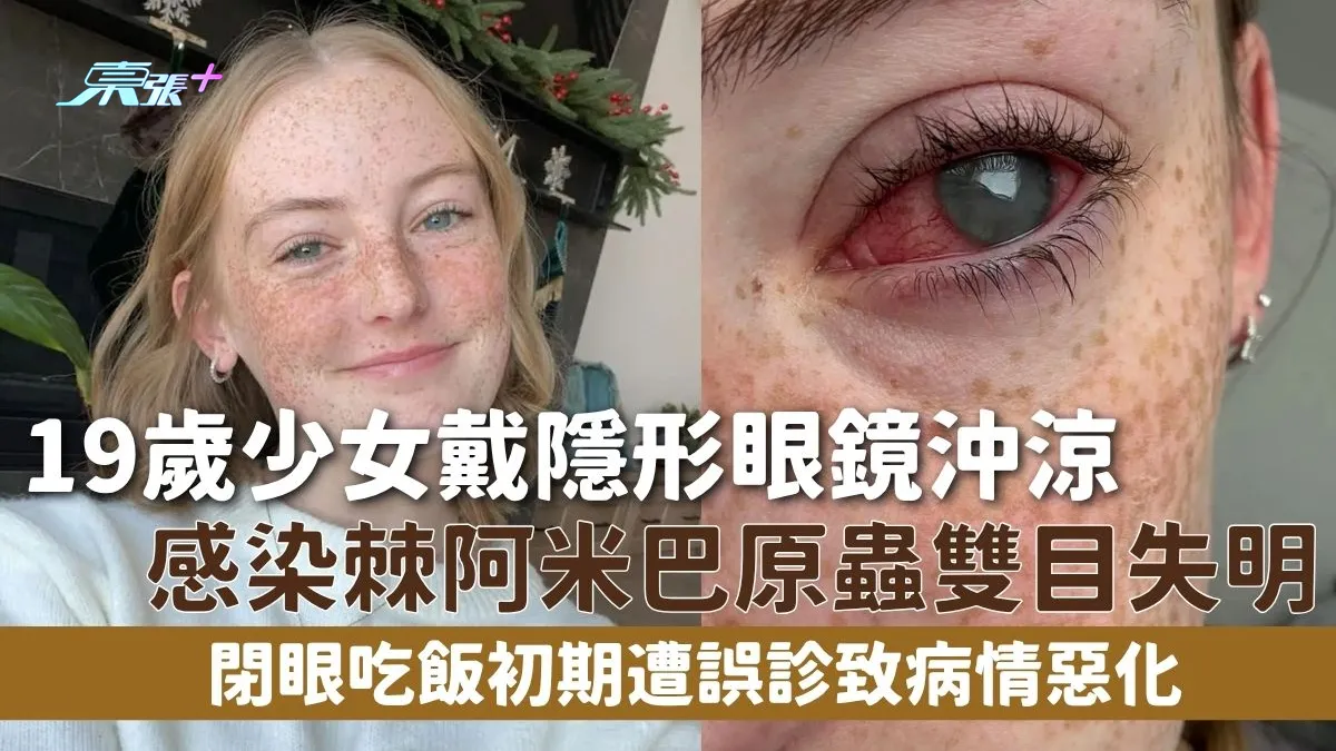 眼睛健康｜19歲少女戴隱形眼鏡沖涼感染棘阿米巴原蟲雙目失明閉眼吃飯初期遭誤診致病情惡化- 東張+ - myTV SUPER