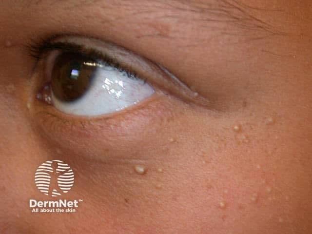 眼周冒白色小顆粒怎麼擠都擠不掉？醫揭「粟粒疹」成因：別當粉刺亂擠