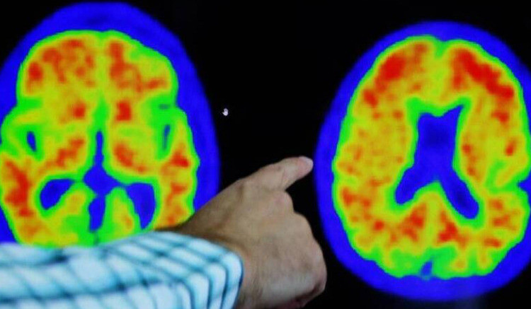 骨質疏鬆藥物或存新用途 研究：與較低失智風險相關 - 自由健康網