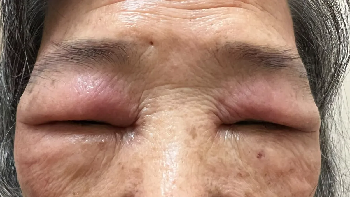 醫療焦點削山藥眼皮腫到睜不開！醫：黏液藏萬根「微型針頭」扎皮膚 2方法削皮不發癢