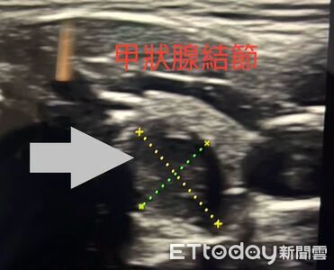 結節僅1公分！32歲男確診甲狀腺癌　醫揭「2大惡性特徵」