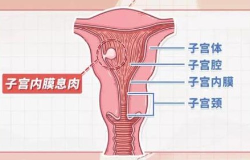 子宮息肉會導致不孕或流產嗎?備孕期間要不要切除及常見疑問解析